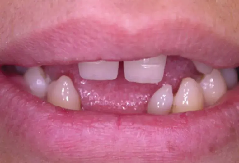 Porcelain Veneers vs. Lumineers: What's the Difference?