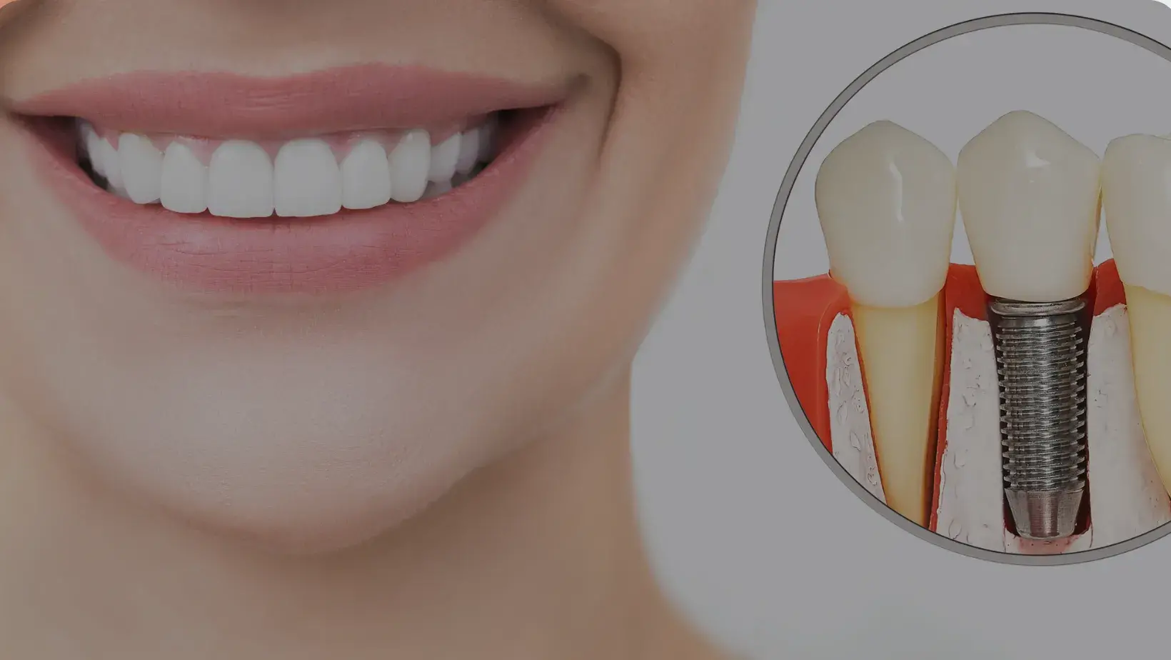 How Much Do Dental Implants Cost in Woodland Hills? (2026 Guide)