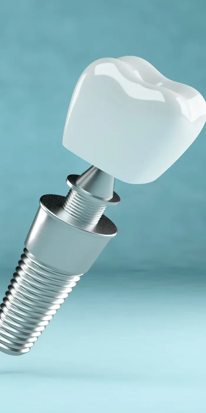 What to Look for When Choosing an Implant Dentist