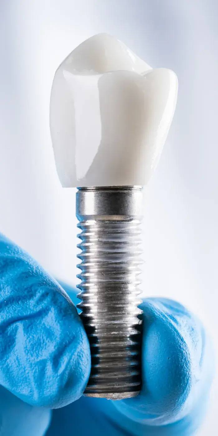 The All on 6 Dental Implants Process