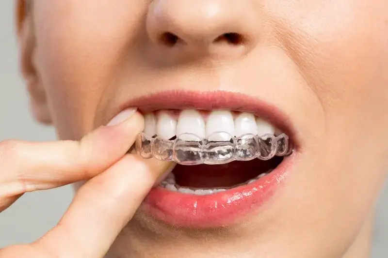 What Is Invisalign?