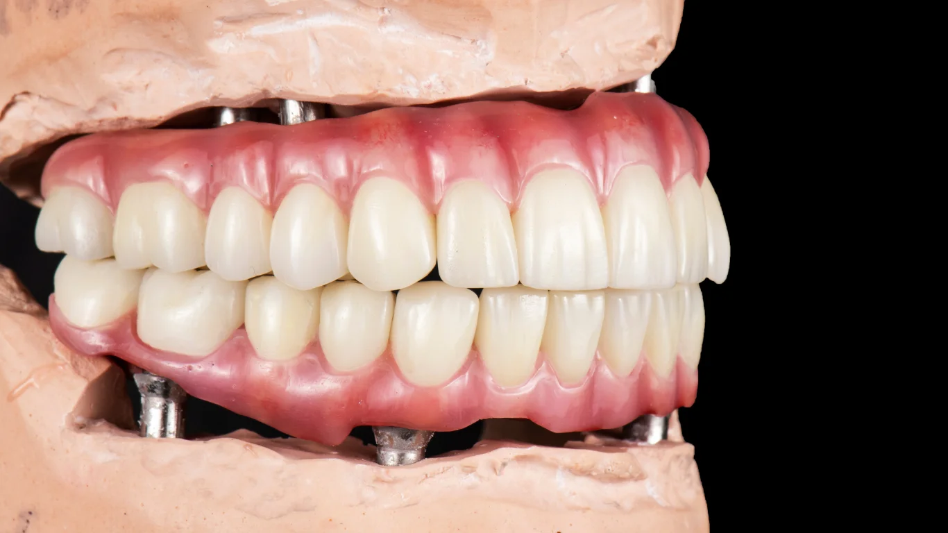 The Long-Term Benefits of Dental Implants: Durability and Aesthetics