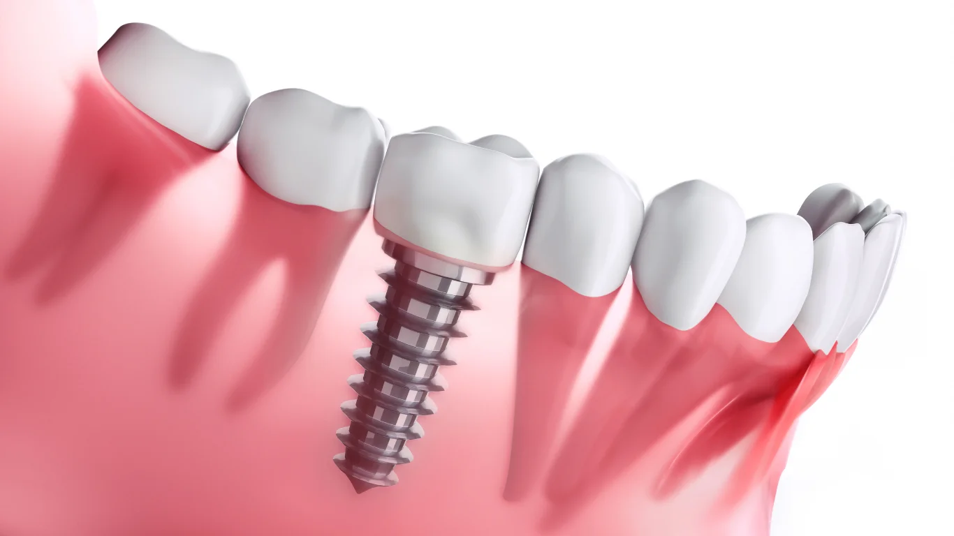 The Importance of Preventive Dental Care in General Dentistry