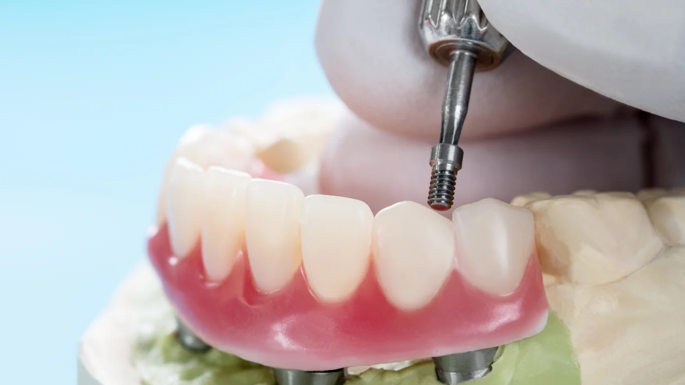 How to Choose the Right Implant Dentist for Your Dental Needs