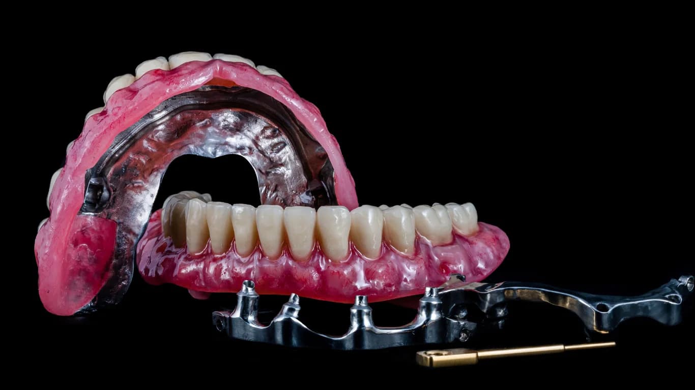 Understanding All on 6 Dental Implants: A Complete Guide to Full-Arch Restoration