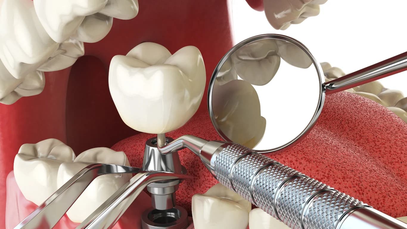 How to Choose the Right Implant Dentist for a Confident Smile