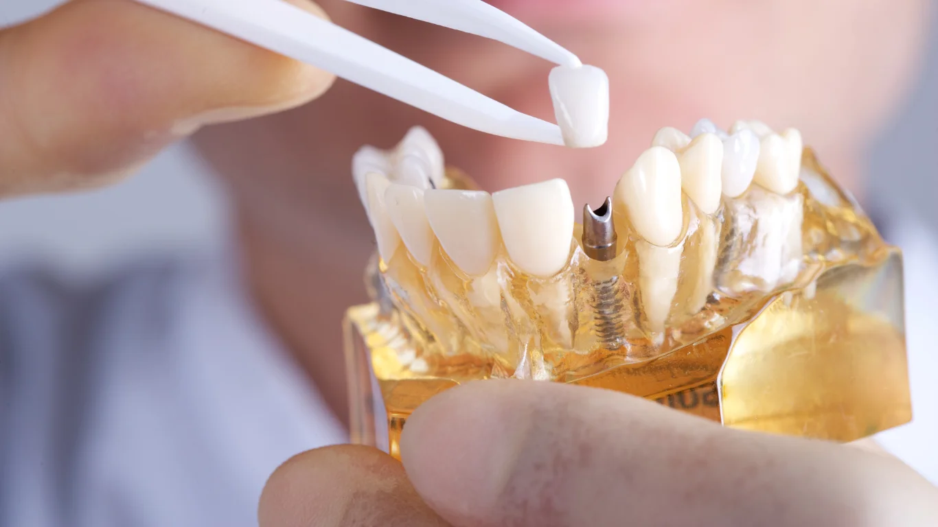 Choosing the Right Implant Dentist: A Step-by-Step Guide