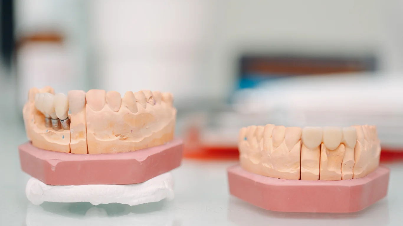 Top Benefits of Dental Implants: Why They're the Best Tooth Replacement Option