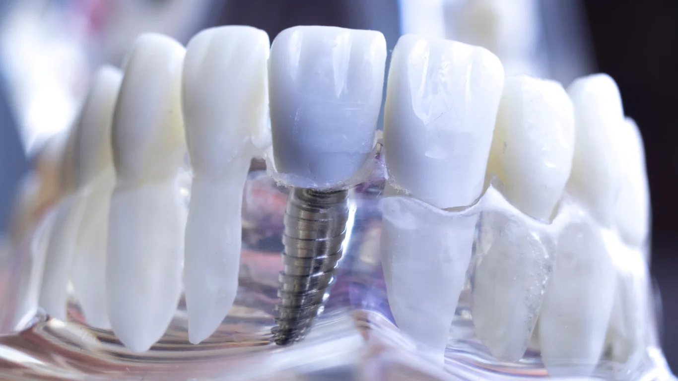 How to Choose the Right Implant Dentist for Your Dental Needs