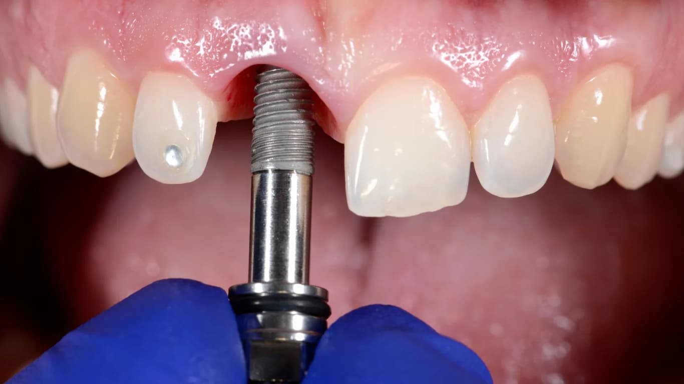 Why Dental Implants Are the Best Solution for Missing Teeth