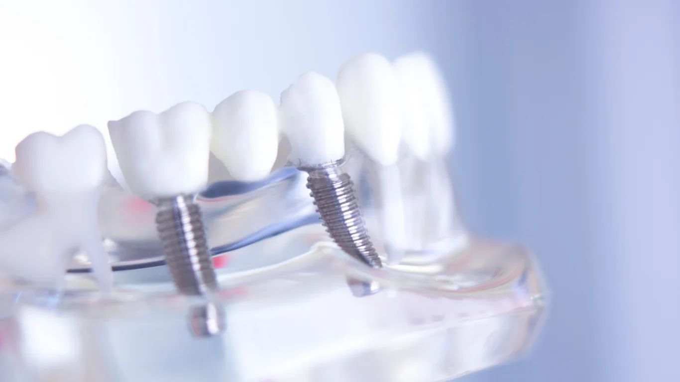 Exploring the Functional and Aesthetic Benefits of Dental Implants