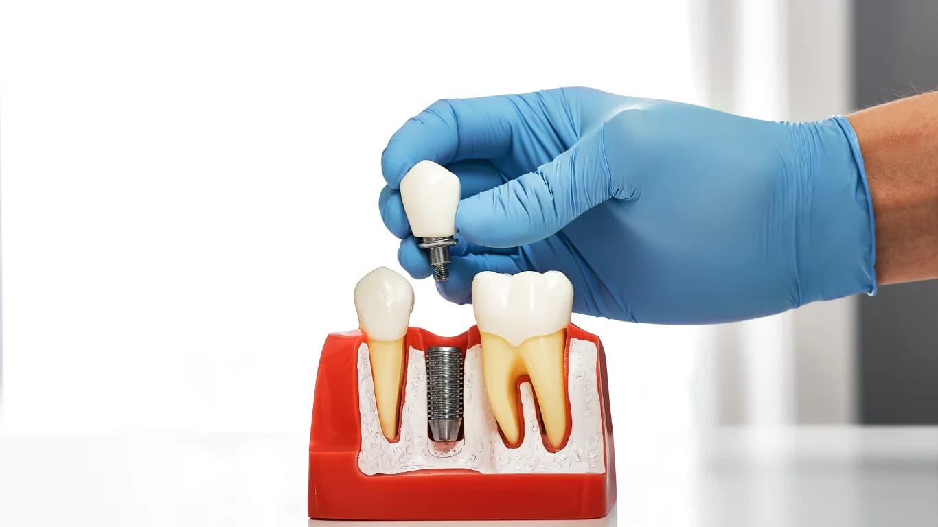 Why Dental Implants Are the Best Choice for Missing Teeth