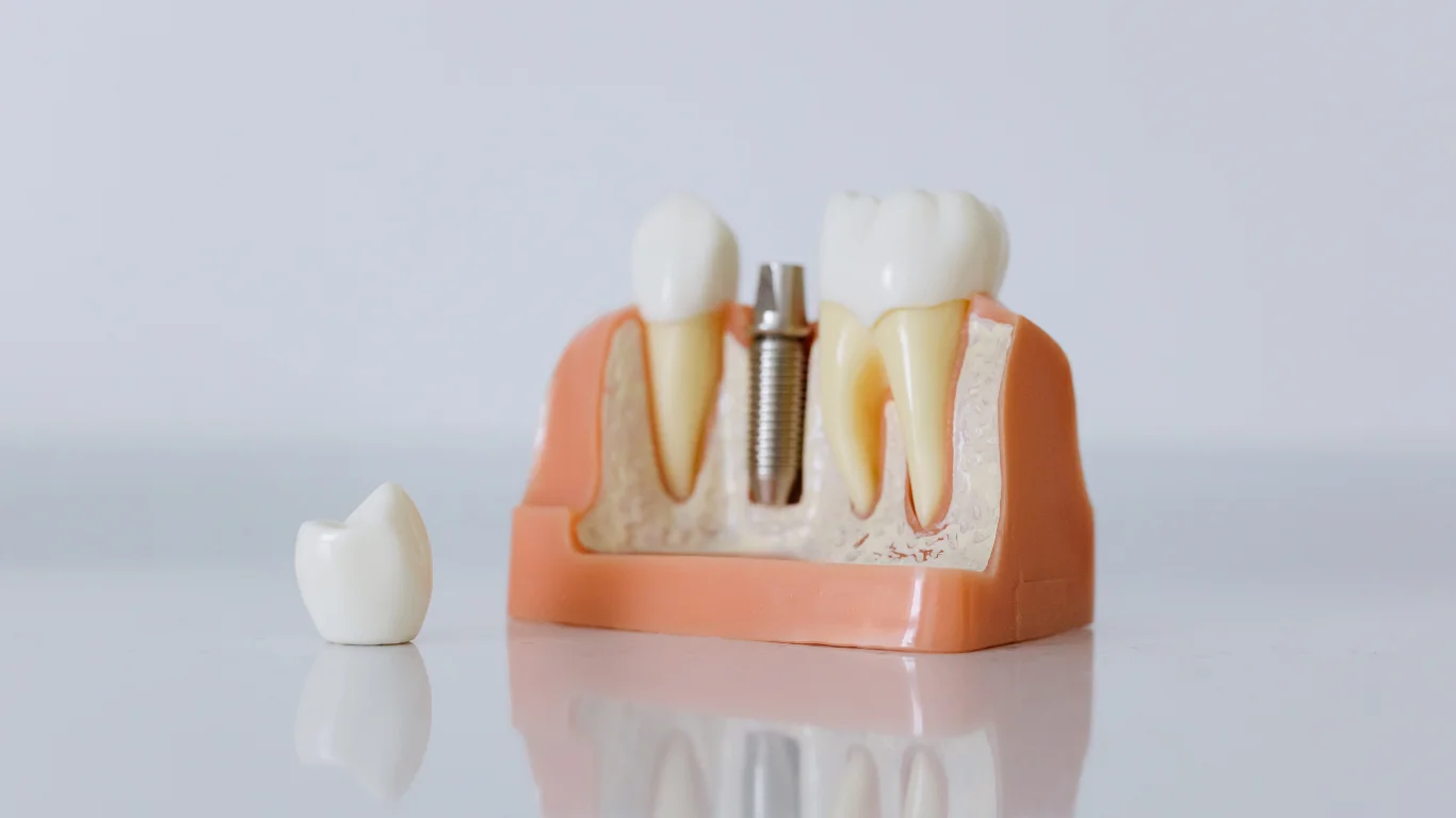 Dental Implants Benefits: Improving Oral Health and Confidence