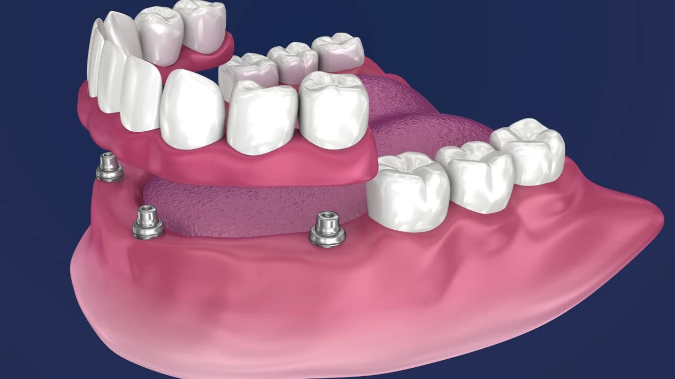 How All on 4 Dental Implants Transform Smiles with Full Arch Restoration