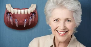 All on 6 dental implants