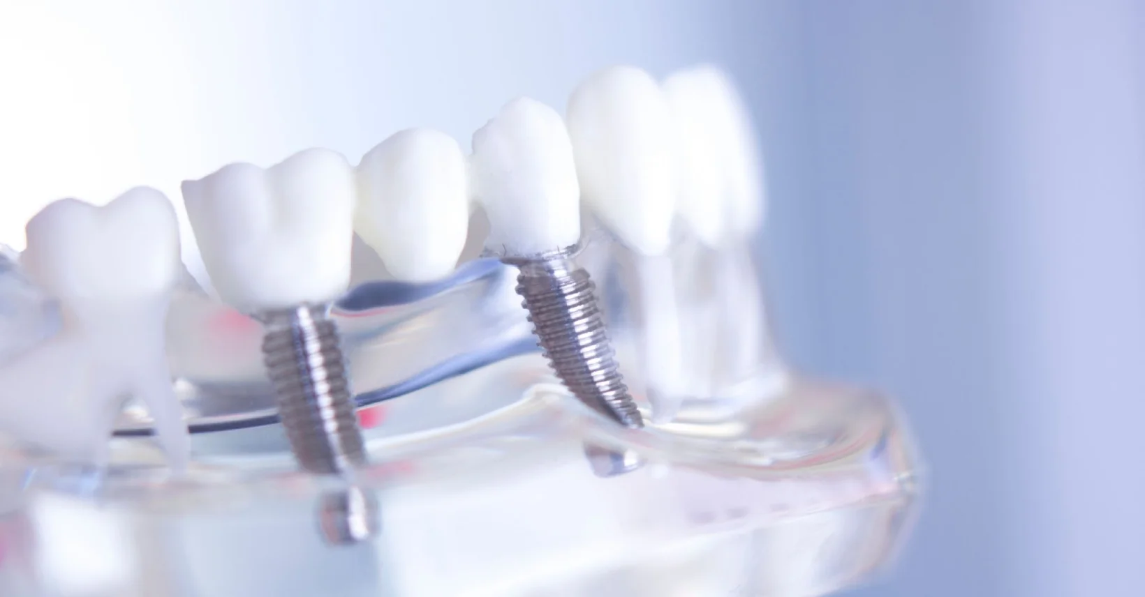 All on X Dental Implants at Dr. Ahdout