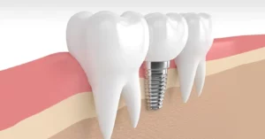 dental implants