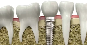 dental implants