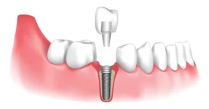 dental implants