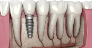 dental implants