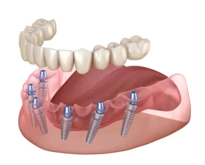 All on X Dental Implants