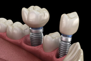 dental implants