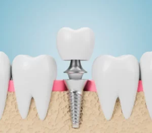 dental implants