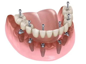 All on 6 dental implants