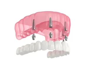 All on 4 dental implants