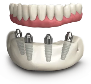 All on 4 Dental Implants