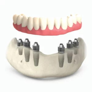 All on 6 dental implants