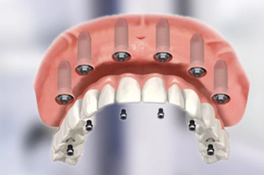 All on 6 dental implants