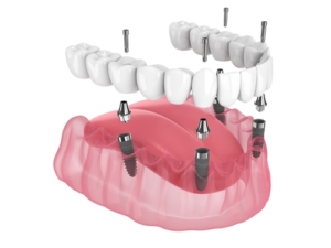 All on 4 dental implants