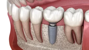 implant dentist