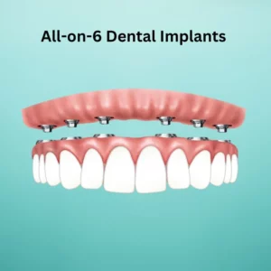 All on 6 dental implants