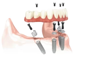 All on 4 dental implants