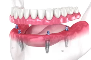 dental implants