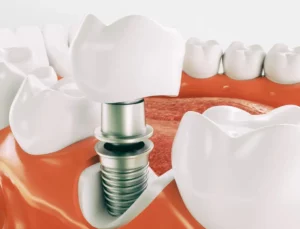 dental implants