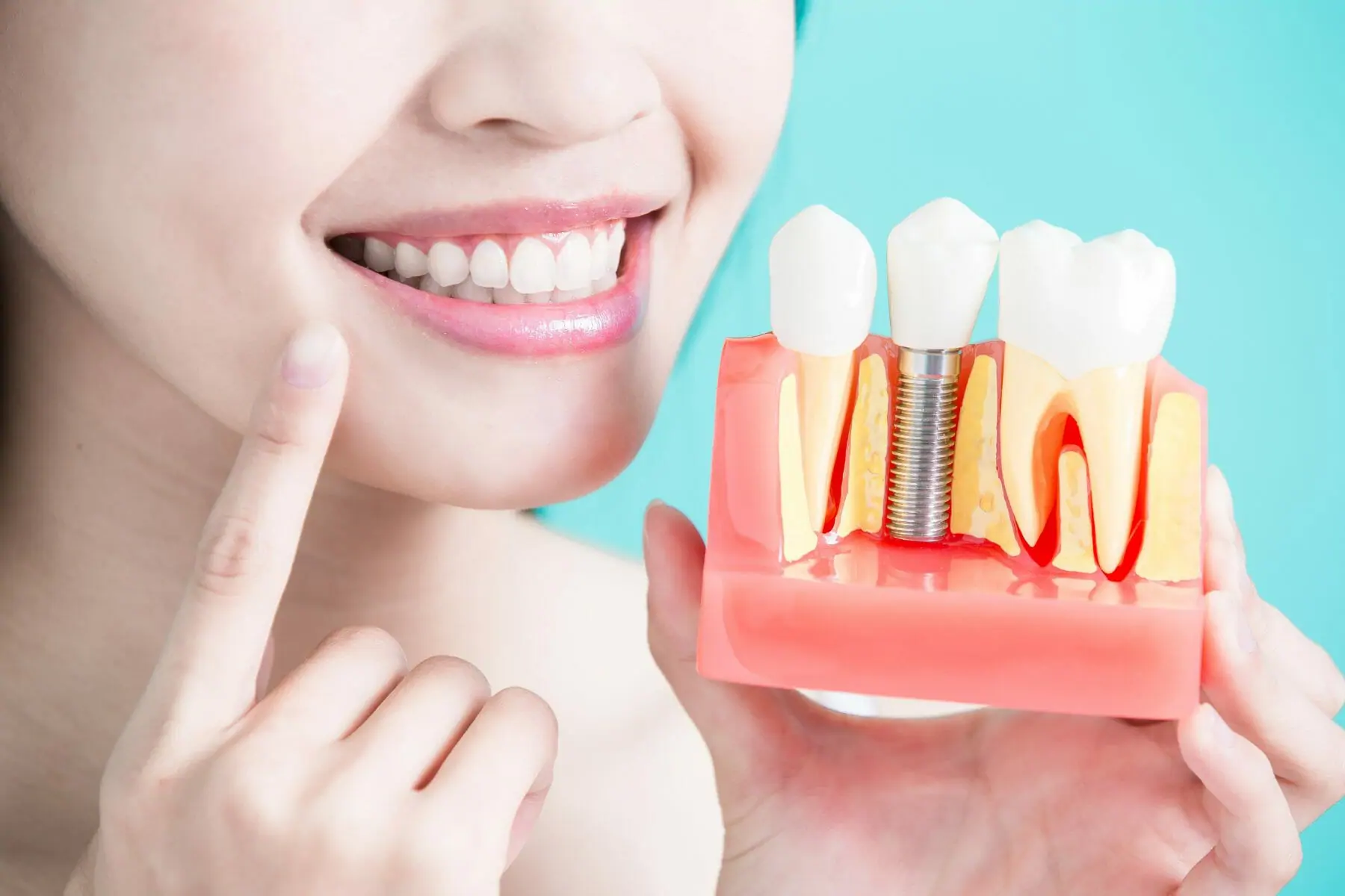 All on X dental implants