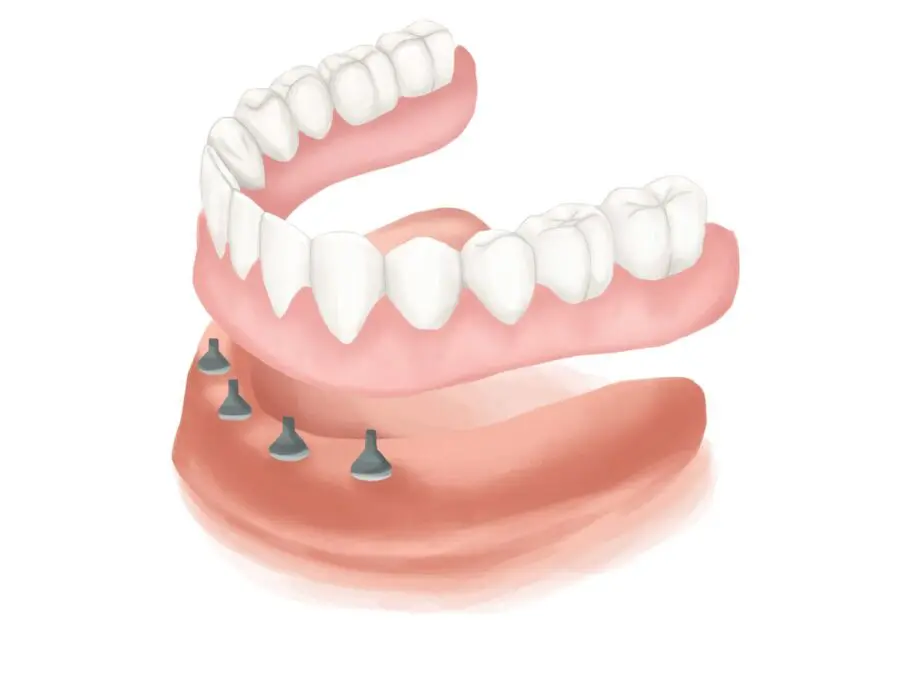 All on 4 dental implants