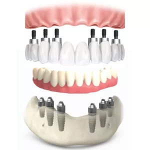 All on 6 dental implants