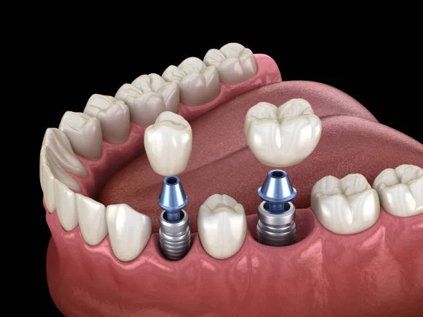 implant dentist