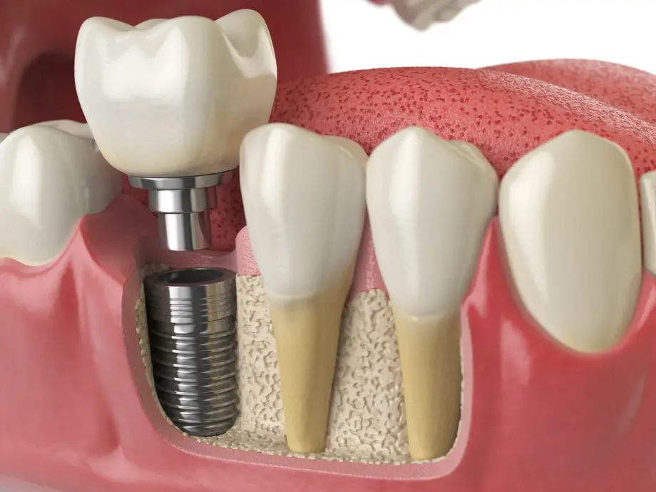 All on X dental implants