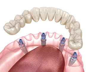 All on 4 dental implants