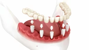 All on 6 dental implants