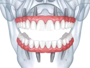 All on 4 dental implants