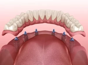 All on 6 dental implants