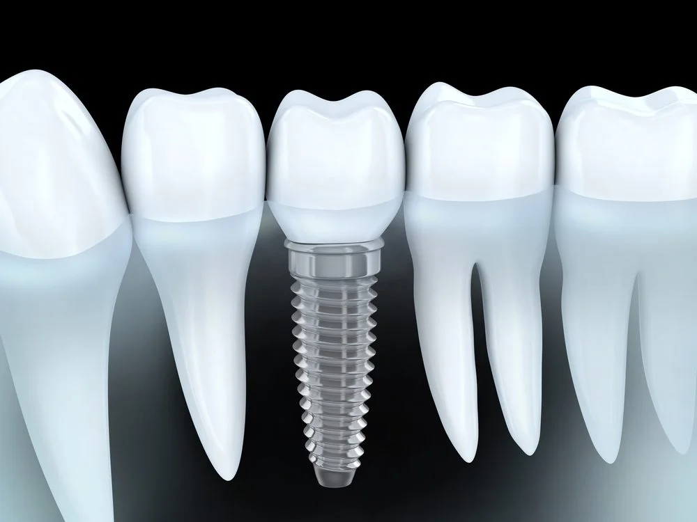 Implant Dentist