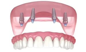 All on 4 dental implants