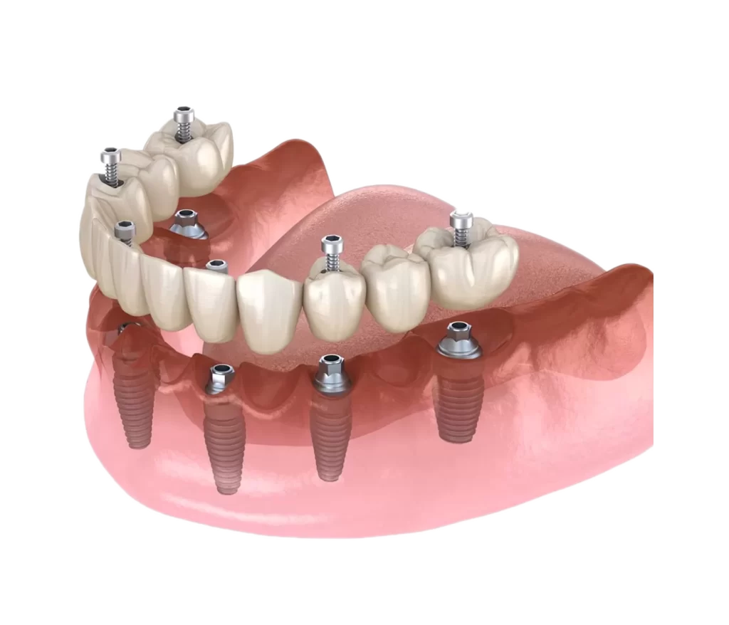 All on 6 dental implants